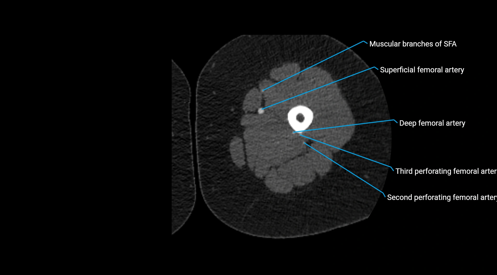 CTA lower limb cross sectional anatomy labelled image _117.webp